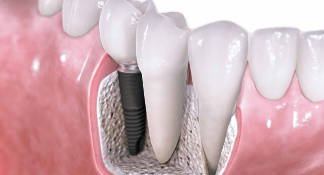 Dental_Implants-950x514